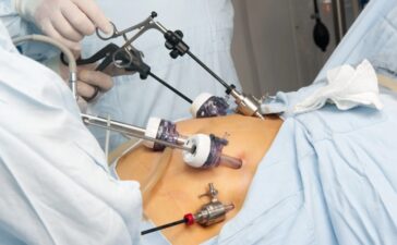 Gastric Bypass Surgery