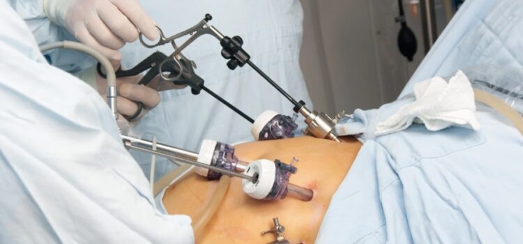 Gastric Bypass Surgery