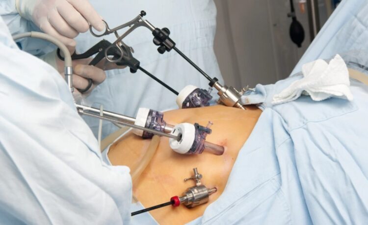Gastric Bypass Surgery